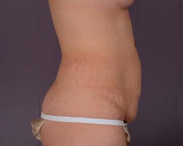 Tummy Tuck Before & After Image