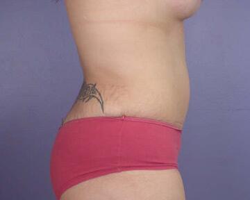 Tummy Tuck Before & After Image