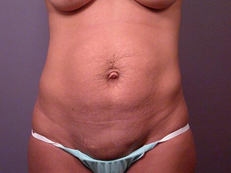 Tummy Tuck Before & After Image