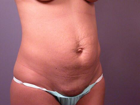 Tummy Tuck Before & After Image