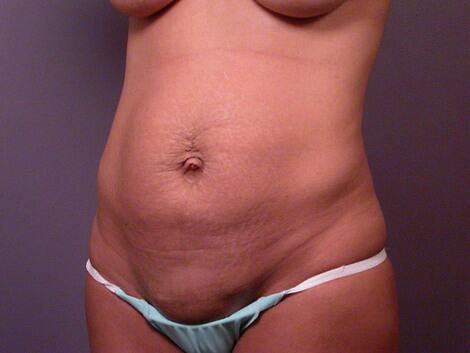 Tummy Tuck Before & After Image