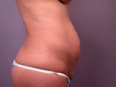 Tummy Tuck Before & After Image