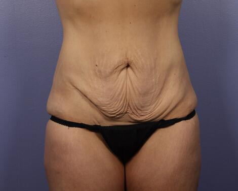 Tummy Tuck Before & After Image