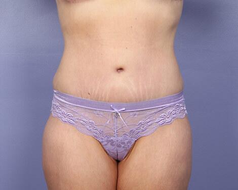 Tummy Tuck Before & After Image