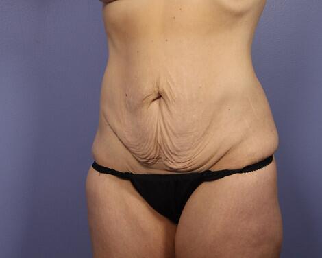 Tummy Tuck Before & After Image