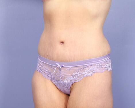 Tummy Tuck Before & After Image