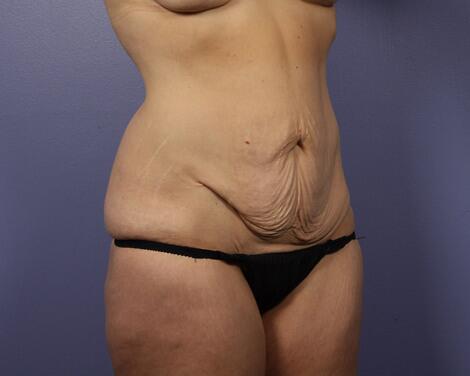 Tummy Tuck Before & After Image