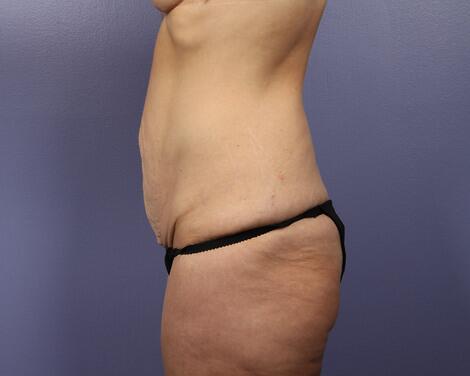 Tummy Tuck Before & After Image