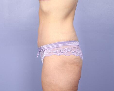 Tummy Tuck Before & After Image