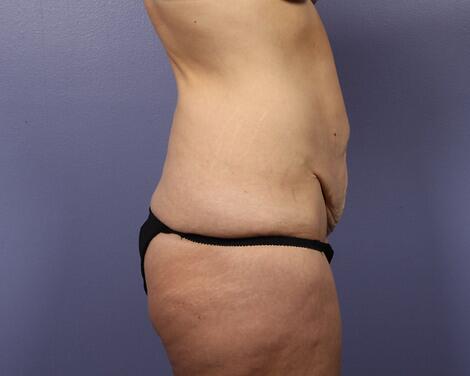 Tummy Tuck Before & After Image