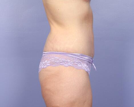 Tummy Tuck Before & After Image