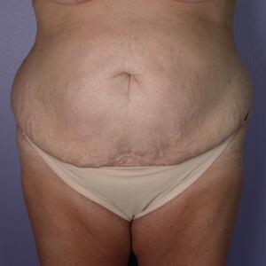 Tummy Tuck Before & After Image