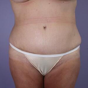 Tummy Tuck Before & After Image