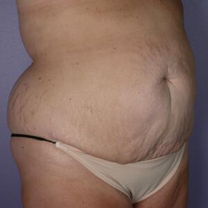 Tummy Tuck Before & After Image