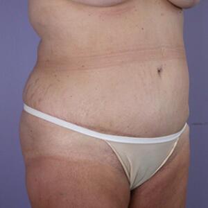 Tummy Tuck Before & After Image