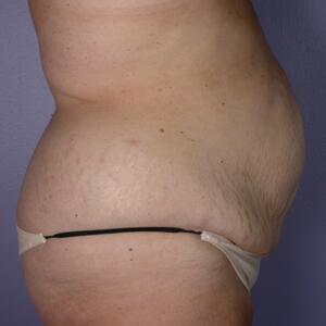 Tummy Tuck Before & After Image