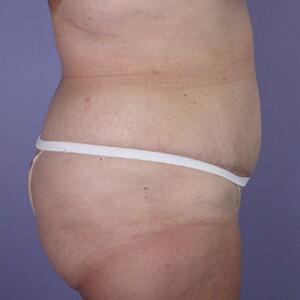 Tummy Tuck Before & After Image