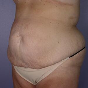 Tummy Tuck Before & After Image