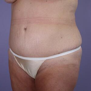 Tummy Tuck Before & After Image