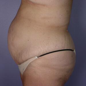 Tummy Tuck Before & After Image