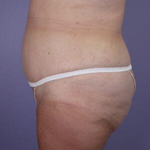 Tummy Tuck Before & After Image