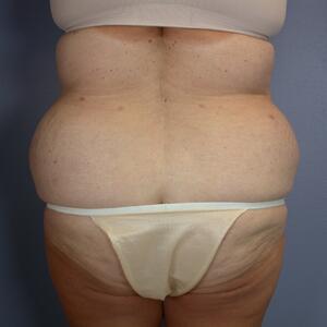 Tummy Tuck Before & After Image