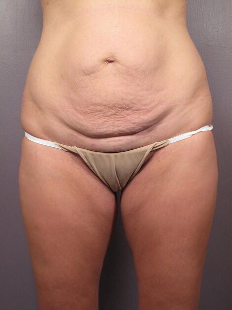 Tummy Tuck Before & After Image