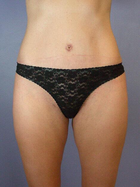 Tummy Tuck Before & After Image