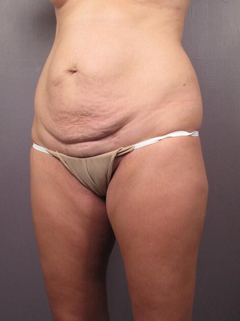 Tummy Tuck Before & After Image