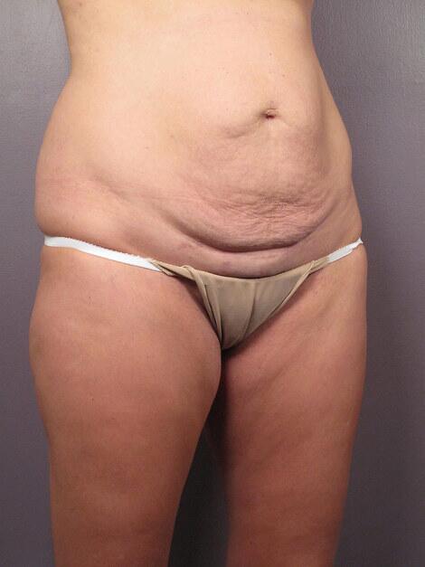 Tummy Tuck Before & After Image