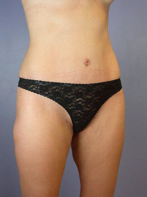 Tummy Tuck Before & After Image