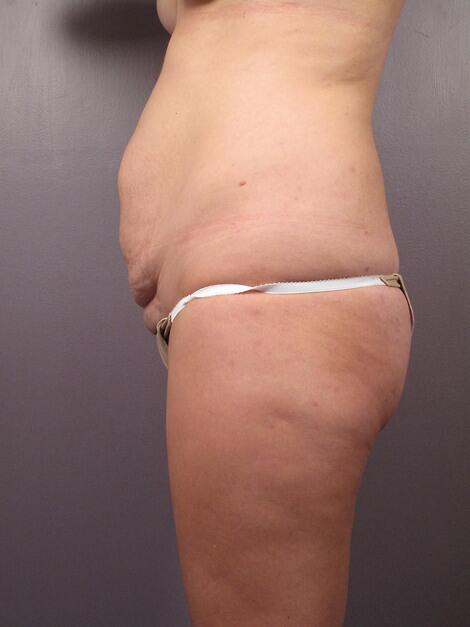 Tummy Tuck Before & After Image