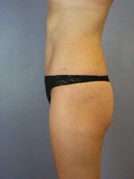 Tummy Tuck Before & After Image