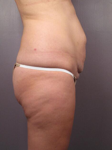 Tummy Tuck Before & After Image