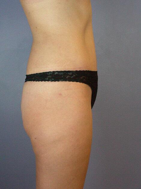 Tummy Tuck Before & After Image