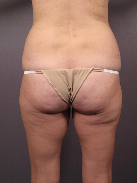 Tummy Tuck Before & After Image