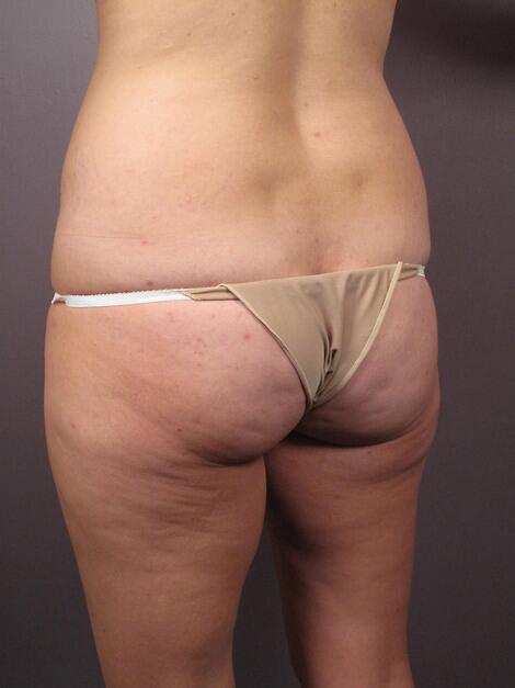 Tummy Tuck Before & After Image