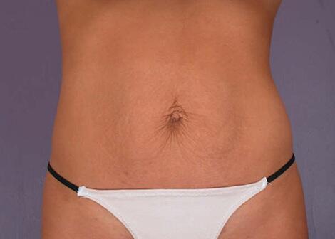 Tummy Tuck Before & After Image