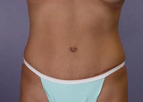 Tummy Tuck Before & After Image