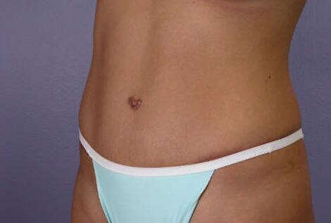 Tummy Tuck Before & After Image