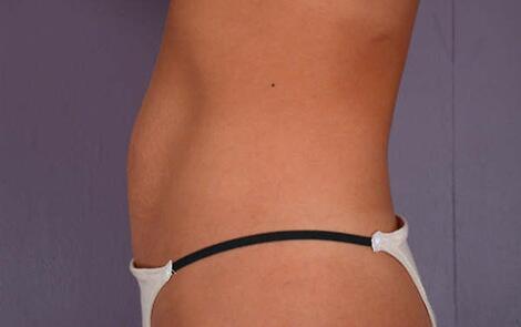 Tummy Tuck Before & After Image