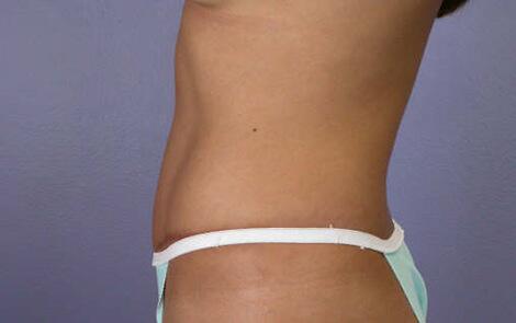 Tummy Tuck Before & After Image