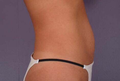 Tummy Tuck Before & After Image