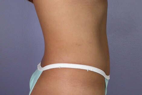 Tummy Tuck Before & After Image