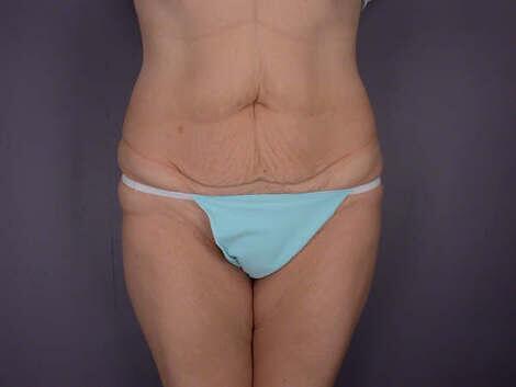 Tummy Tuck Before & After Image