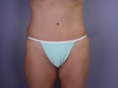 Tummy Tuck Before & After Image