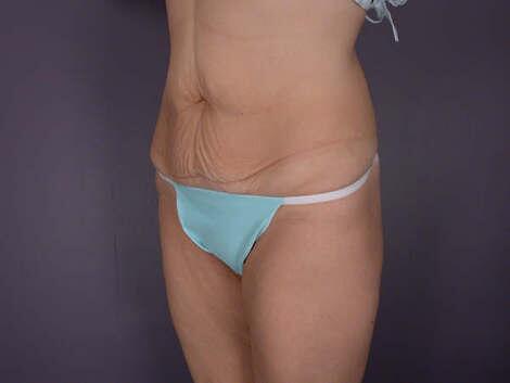 Tummy Tuck Before & After Image