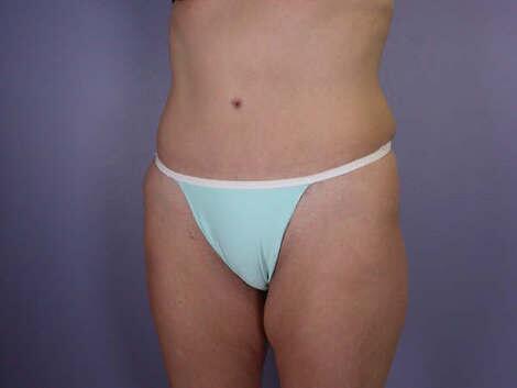 Tummy Tuck Before & After Image