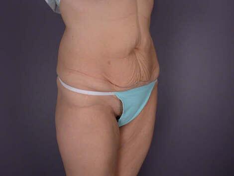 Tummy Tuck Before & After Image