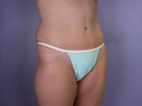 Tummy Tuck Before & After Image